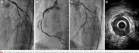 Figure 2 from Recurrent Stent Thrombosis in a Patient with ...