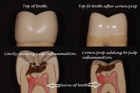 Tooth hurts after crown? - Why does tooth hurt after crown? - Bauer Smiles