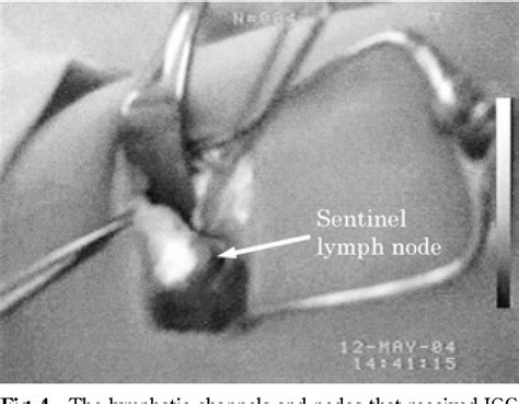 lymph node biopsy | Semantic Scholar