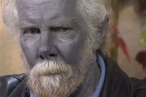 Why this man’s skin turned blue