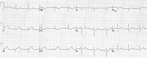 Inferior STEMI • LITFL • ECG Library Diagnosis