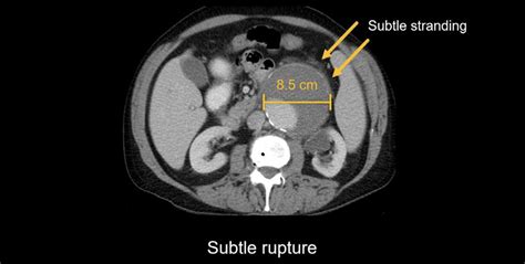 Abdominal CT: aortic aneurysm • LITFL • Radiology Library