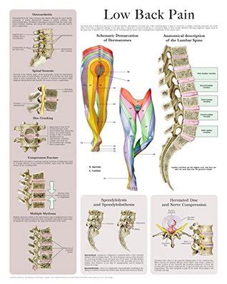 Low Back Pain e-chart: Quick reference guide by HC-HealthComm