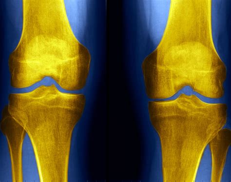 Knee X-Rays and Detecting Abnormalities