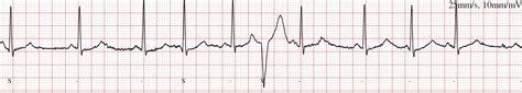 Ectopic Beats Treatment In London | Ectopic Heartbeat | Dr Boon Lim