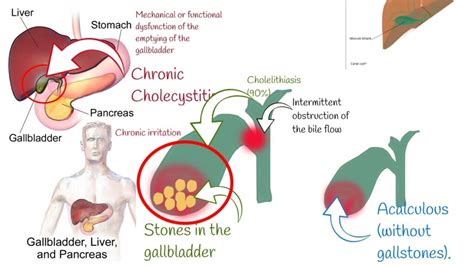 Chronic Vs Acute Cholecystitis: Understanding The Differences And Implications - Ask The Nurse ...