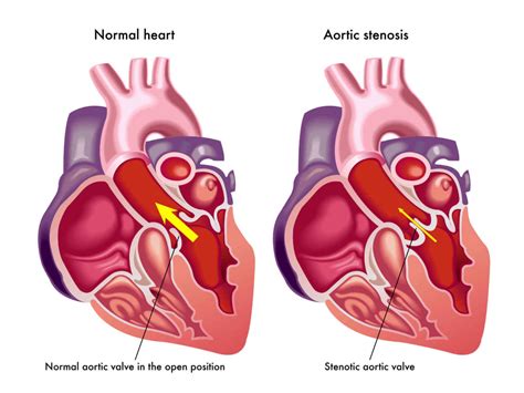 Facts About Aortic Stenosis - Dr. Peter Mikhail