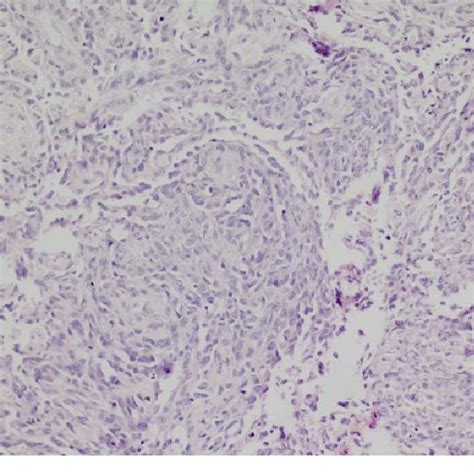 Section showing tumor composed of spindle cells Χ100 | Download ...