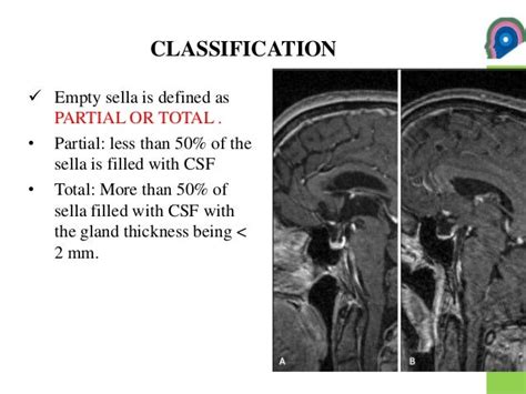 Empty sella syndrome