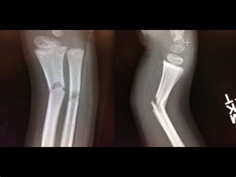 angulated forearm fracture - YouTube