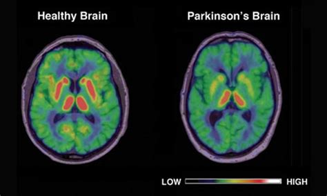 6m suffer from Parkinson’s disease worldwide: study - Pakistan - DAWN.COM