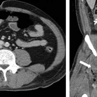 (PDF) Psoas and Thigh Abscess Caused by Perforated Retrocecal ...