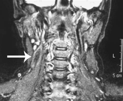 T2-weighted MRI scan of neck (coronal view). The tumour | Open-i