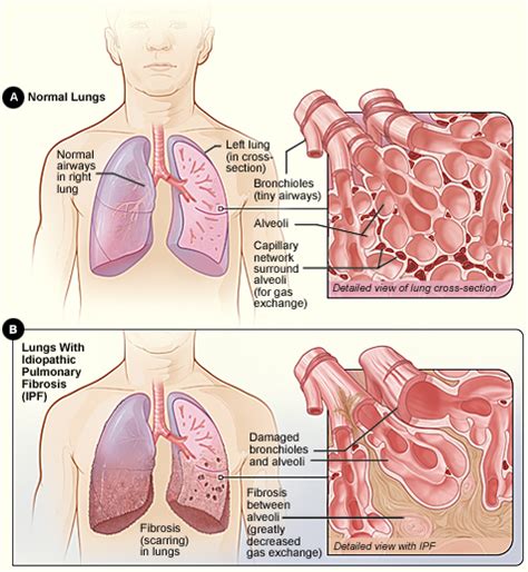 Interstitial Lung Diseases - What Are Interstitial Lung Diseases? | NHLBI, NIH