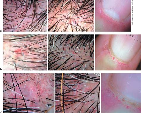 Figure 1 from Clinical and Dermoscopic Features of the Scalp in 31 ...