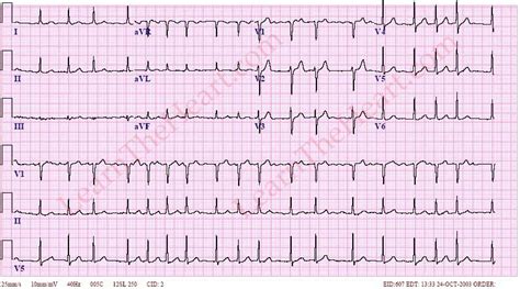 Atrial Fibrillation with RVR ECG 1 | LearntheHeart.com