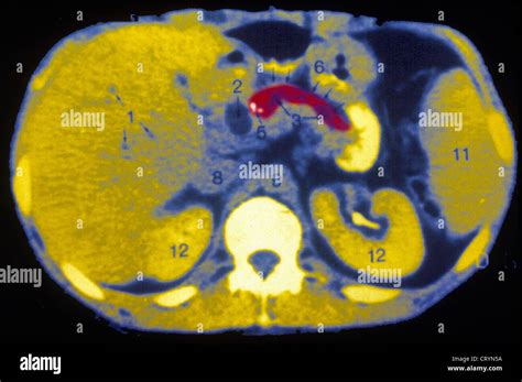 PANCREATIC CALCULUS, SCAN Stock Photo - Alamy