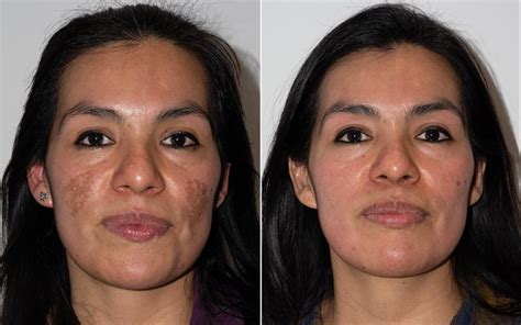 Conozca todo acerca del tratamiento del melasma con ácido tranexámico - Total Dermatology