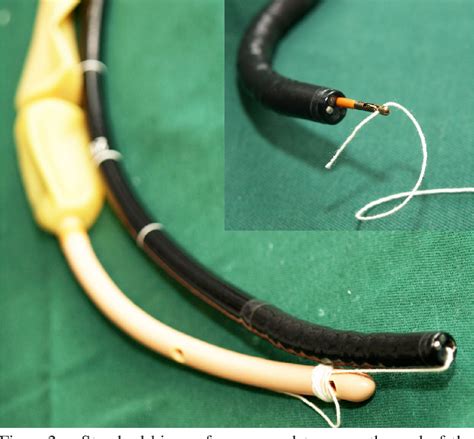 Figure 2 from Inserting the Sengstaken-Blakemore tube successfully in a difficult case of ...