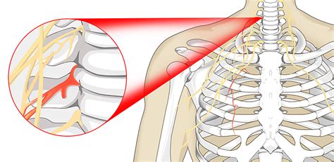 Radiculopathy Surgery in NJ and NYC