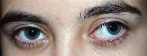 Strabismus (Crossed Eyes) - Causes & Treatment | Lions Eye Institute