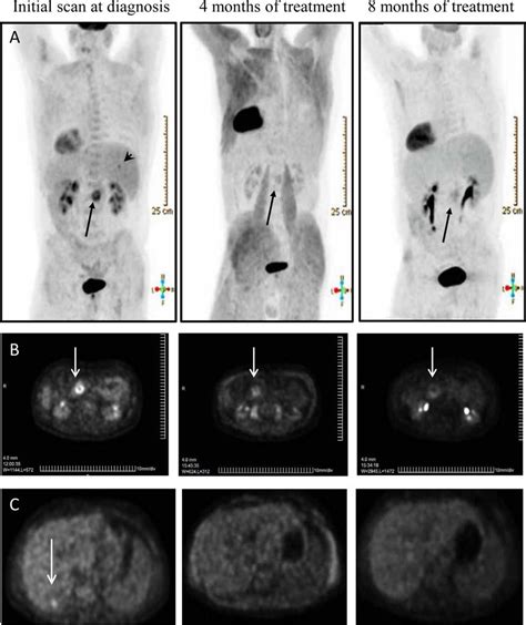 Stage 4 Pancreatic Cancer Spread To Liver Survival Rate - CancerWalls