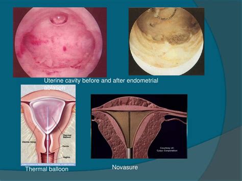 Endometrial Ablation