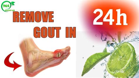 [GOUT TREATMENT] How to Massage for Feet to Remove Gout in 24h HEALTHY ...