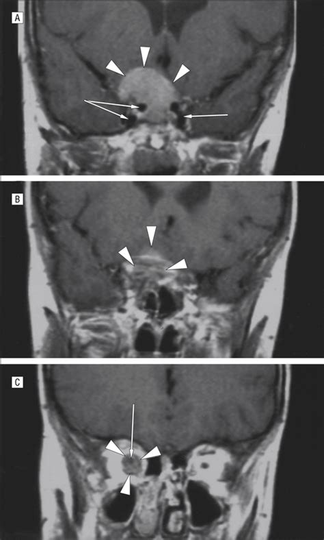 Optic Nerve Sheath Meningiomas in Patients With Neurofibromatosis Type 2 | Congenital Defects ...