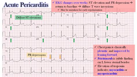 What Is Acute Mi In Ecg - Design Talk