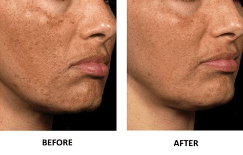 Laser Skin Resurfacing in Virginia Beach: Fraxel Laser Treatment for Body