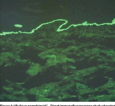 Figure 1 from Reverse Koebner Phenomenon in Bullous Pemphigoid – A Case ...