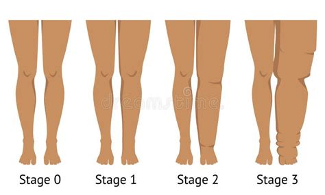 Women`s Legs in Different Stages of Lymphedema Stock Vector ...