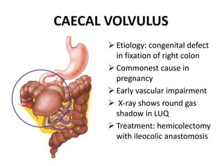 Volvulus | PPT