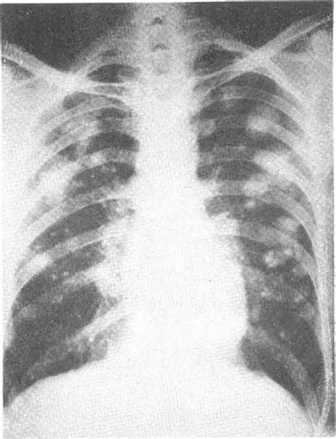 Causes of caplan syndrome - MEDizzy