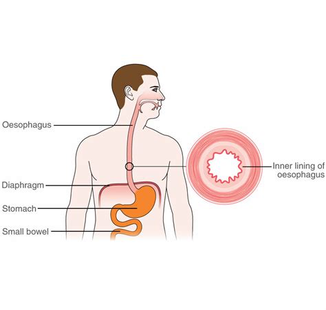 Barrett's Esophagus Cancer Symptoms