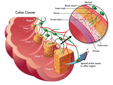 Colorectal Cancer Treatment In Dubai | Dubai Gastroenterology Clinic