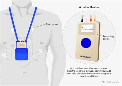 Holter Monitor: Why It's Done, and What to Expect - Healthgrades