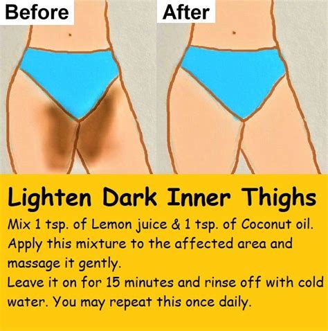 6 Home Remedies to Get Rid of Dark Inner Thighs: Lighten Dark Inner Thighs in 2020 | Pretty skin ...