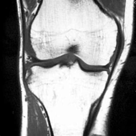 Segond fracture | Radiology Reference Article | Radiopaedia.org | Radiology, Fracture, Anterior ...