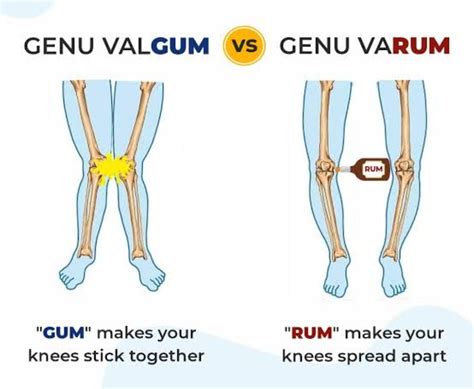 Genu Valgum Vs Genu Varum #orthopedics #medicine # ...