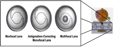 Premium IOL Options Lens Set | Gulden Ophthalmics