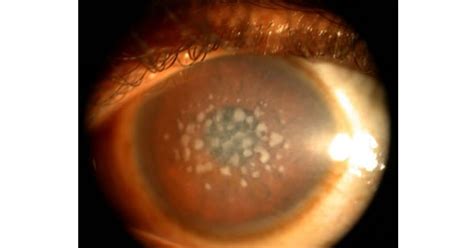 Corneal Dystrophies - www.medicoapps.org