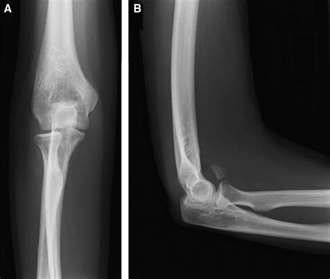 Isolated anterolateral fracture of the coronoid process of the ulna: a ...