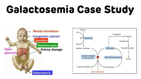 Galactosemia Case Study || Classical Galactosemia || NEXT PG Biochemistry - YouTube