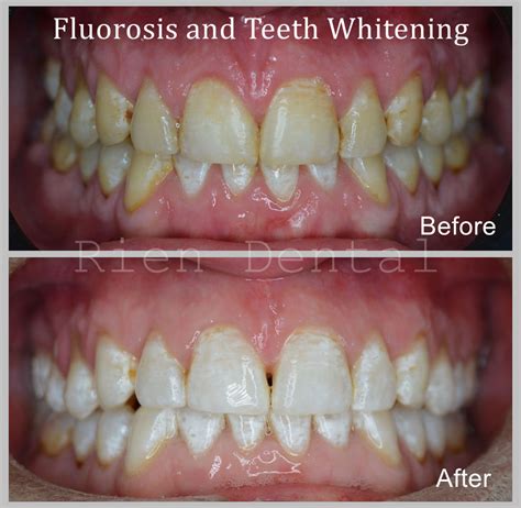 Fluorosis and teeth whitening