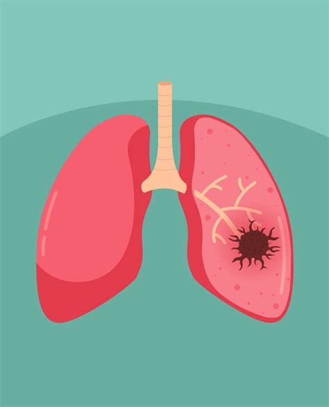 Lung cancer - SynappseHealth