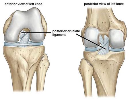 Posterior Cruciate Ligament Tears - From Diagnsosis to Treatment