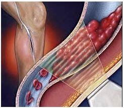 Fate Of Thrombus: What Happens after Thrombus Formation ? | MedicoTips.Com