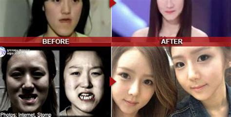 Nothing Really Cosmetic About V-line Jaw Surgery Here: Twins Fixed ...